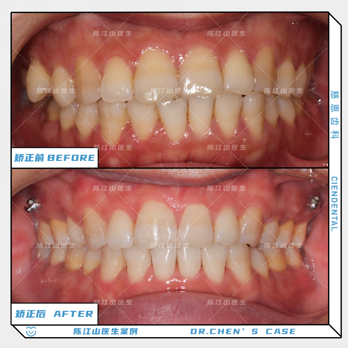 矫正后,牙齿中线一定对齐吗?
