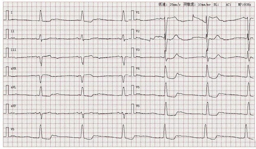心电图图库丨二度ii型21房室传导阻滞系列