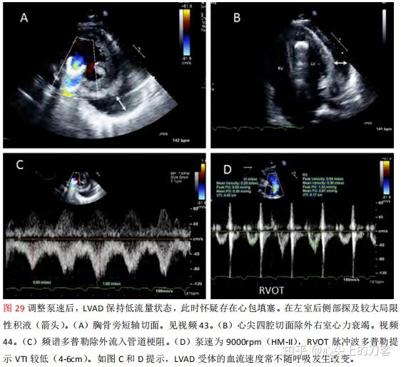 美国超声心动图学会指南及标准超声心动图在左心室辅助装置管理中的应用 - 知乎