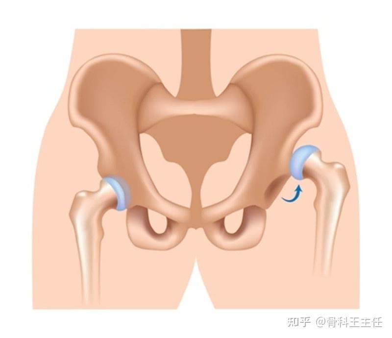一条腿越来越短容易被忽视的髋关节发育不良
