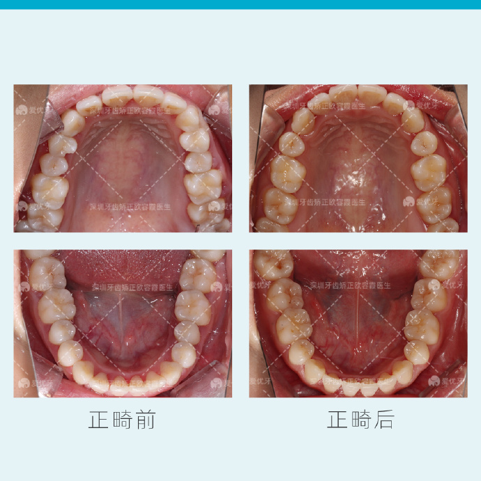 深圳牙齒矯正關於隱形矯正所有你想知道和不想知道的都在這裡了