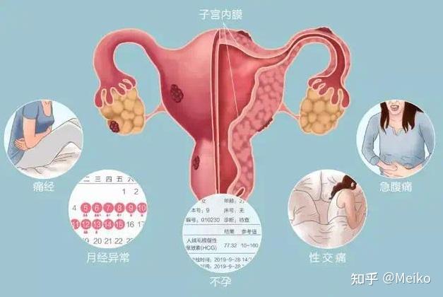 带你了解子宫内膜异位症病因预防