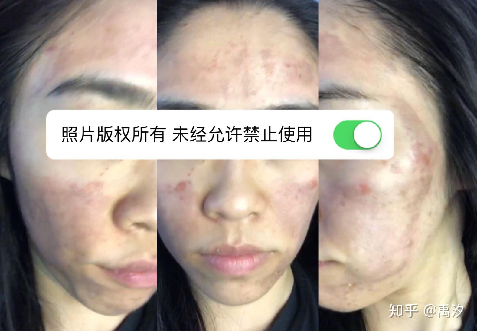 看过这个,你还敢自己刷酸吗? - 知乎