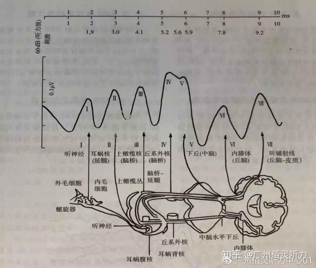 带你了解什么是听性脑干反应(ABR) - 知乎