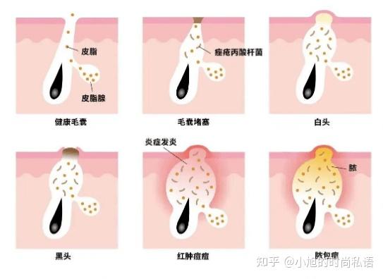 闭口、粉刺、痘痘三者区别? - 知乎