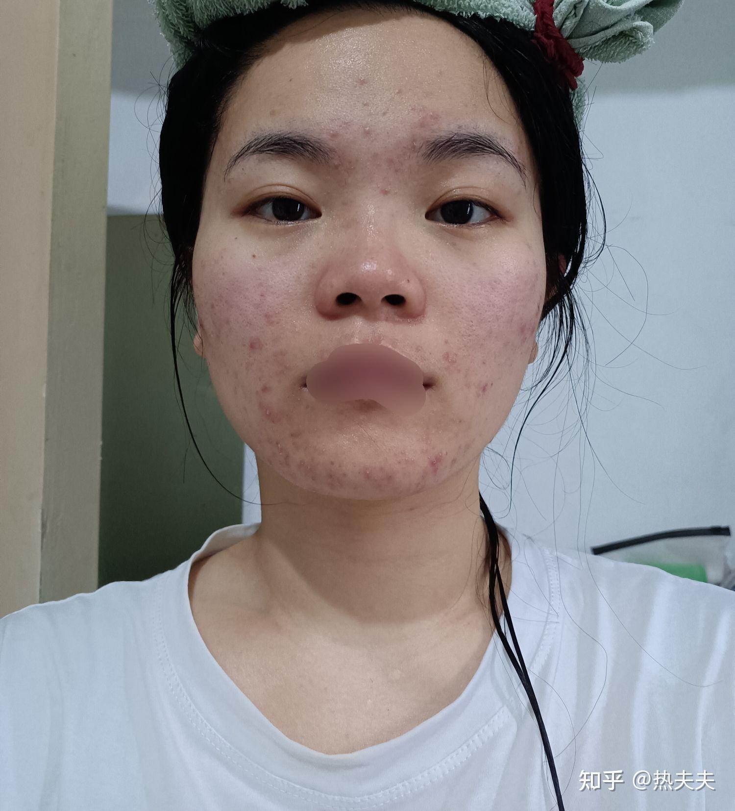 想問一下女生滿臉痘痘真的會被同學覺得很醜嗎