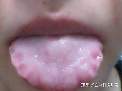 齿痕舌怎么调理才能好 女性齿痕舌吃什么药 健脾丸治好了齿痕舌