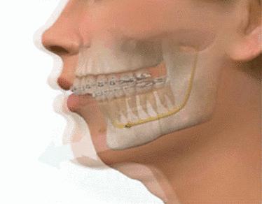 下颌后缩是由于下颌骨发育不全或者先天性缺牙以及翼外肌功能不全等