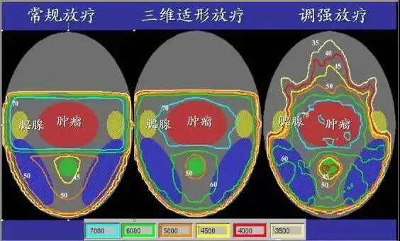 是三維適形放射治療技術的發展,它可以對放射野內的射線強度進行調整