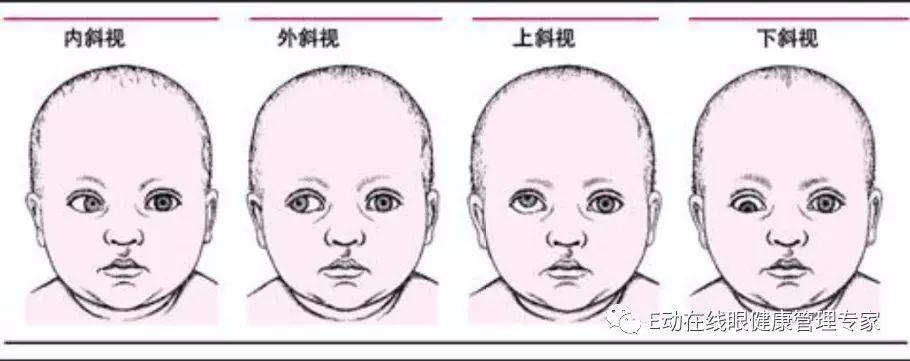 弱视有哪些潜在影响