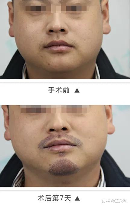 常见的胡子类型有h型,w型,u型和o型胡须,络腮胡,好莱坞胡,巴尔博式胡