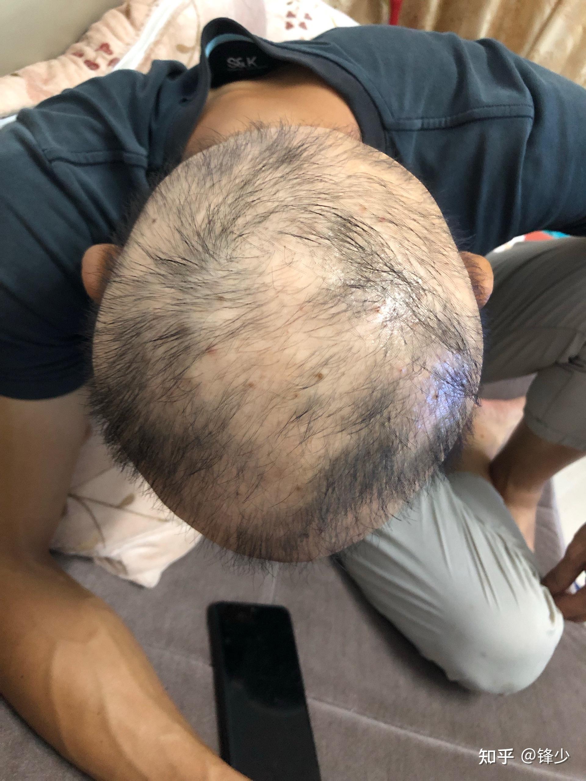 普秃3年正在治疗中