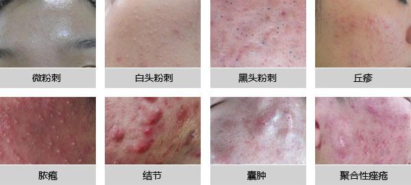 2青春痘的七种类型