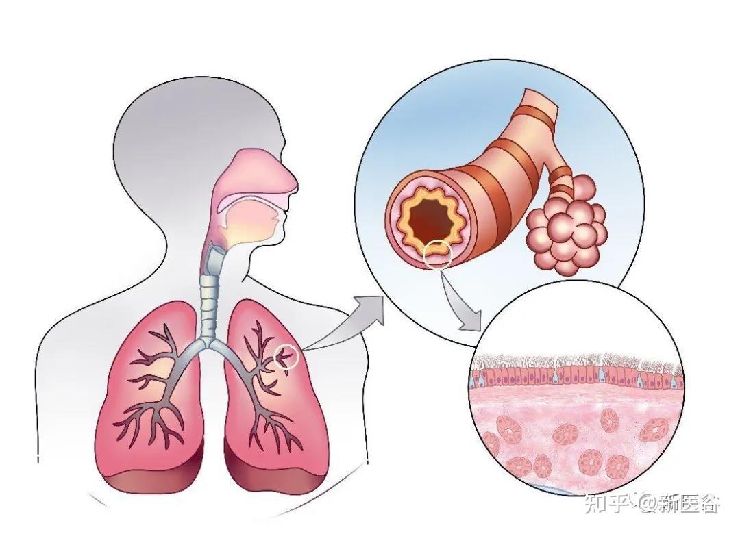 哮喘发炎支气管炎 向量例证. 插画 包括有 了解, 器官, 黏液, 设计, 微生物学, 医学, 的闪烁 - 193605817