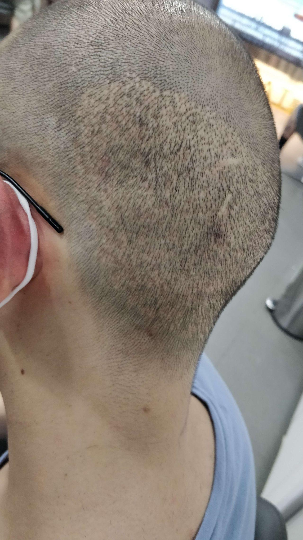 植髮案例分享疤痕植髮 – 林宜蓉醫師植髮