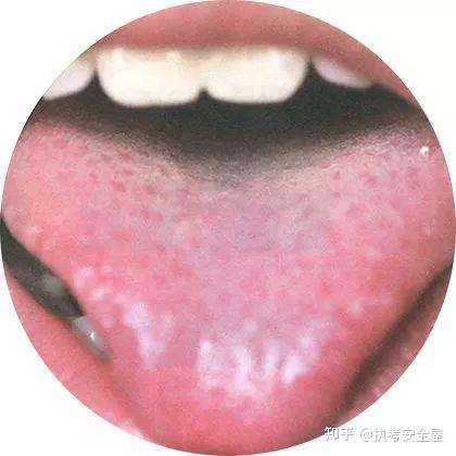 【舌诊大全】120种常见的舌苔超清彩色图谱,建议收藏! - 知乎