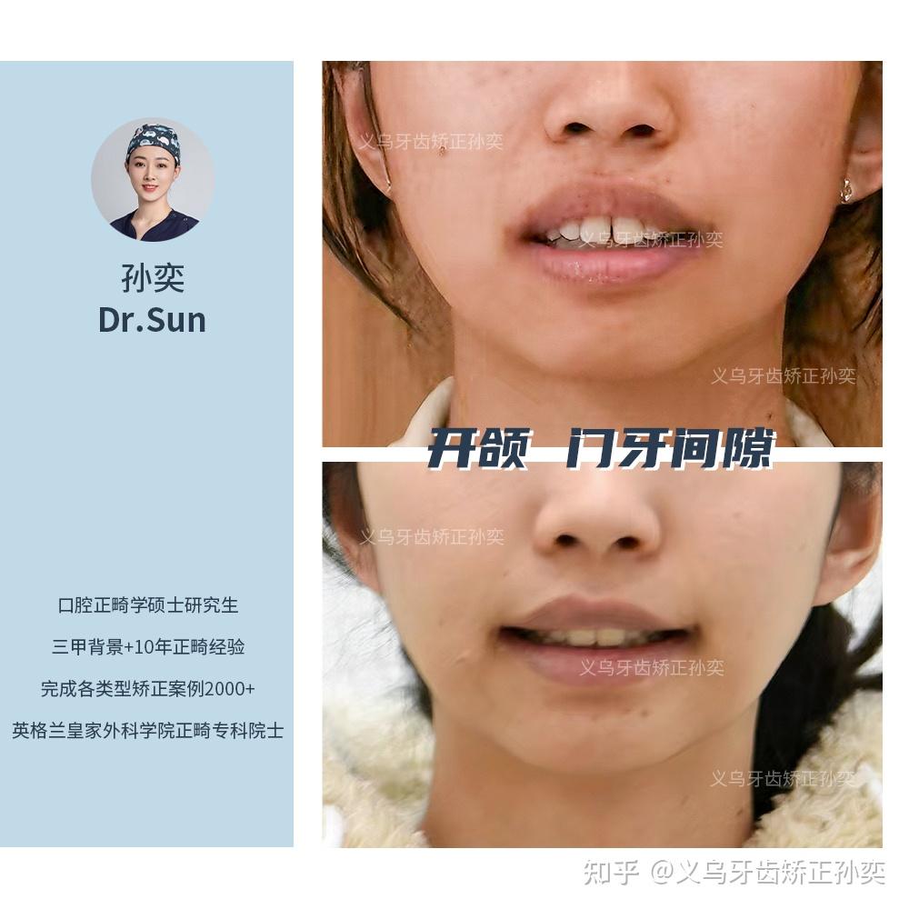 义乌傅氏口腔开颌门牙间隙矫正案例分享! - 知乎