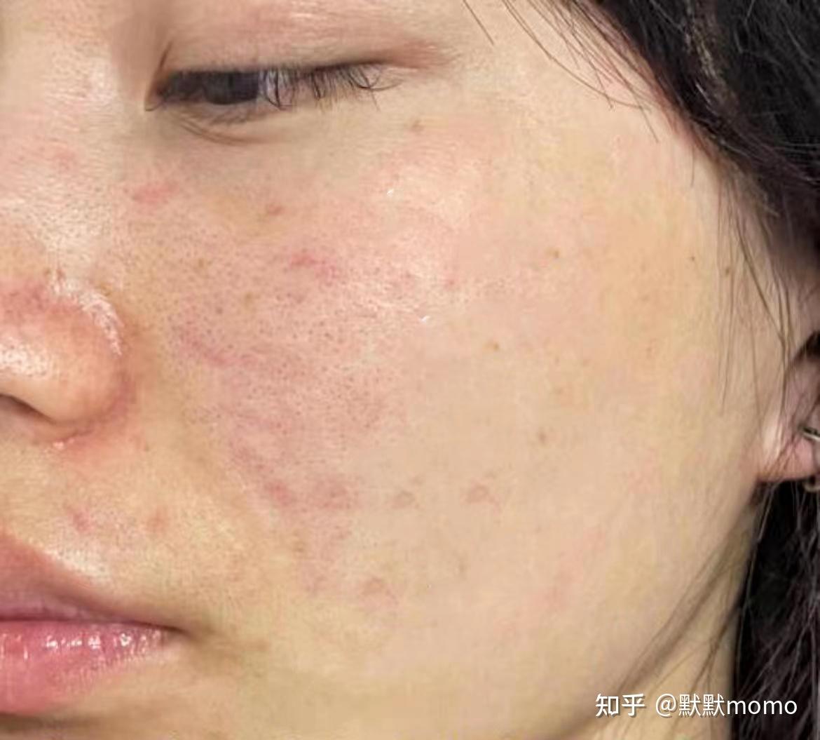 为什么医学生强烈建议你皮肤出现暗沉粗糙的时候直接用a醇抗老