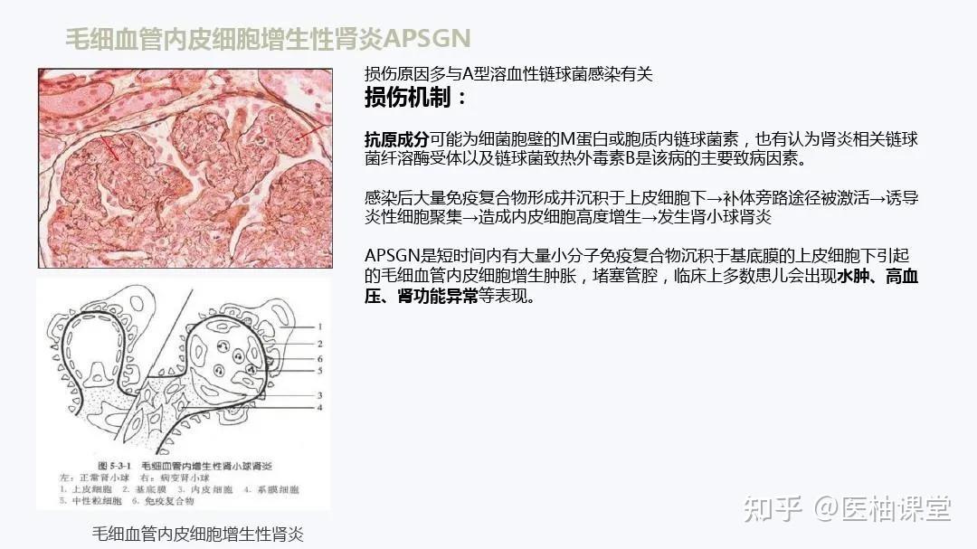 扁桃體與iga腎病(igan)發病扁桃體周圍膿腫扁桃體結石扁桃體息肉