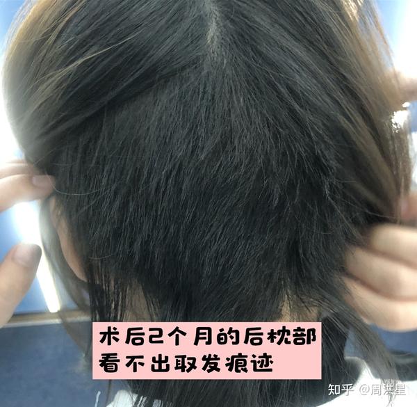 植发验血吗(植发需要验血吗)