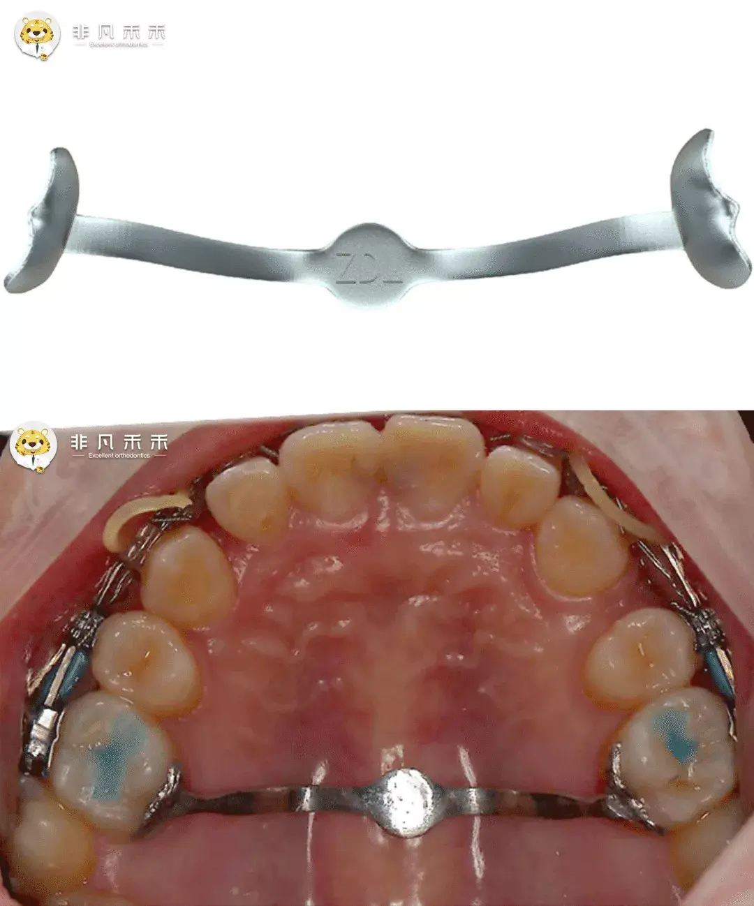 正畸病例牙拥挤不齐Ⅲ度拥挤拔牙矫治病例1例