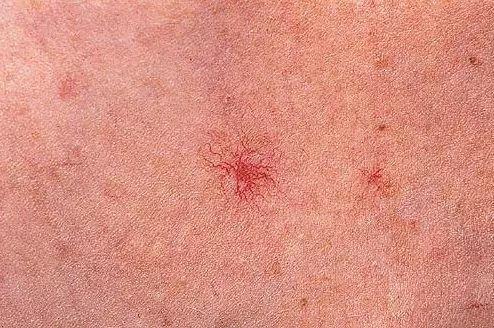 蜘蛛痣蜘蛛痣也叫毛细血管扩张痣,本质是一各特殊类型的微小血管畸形