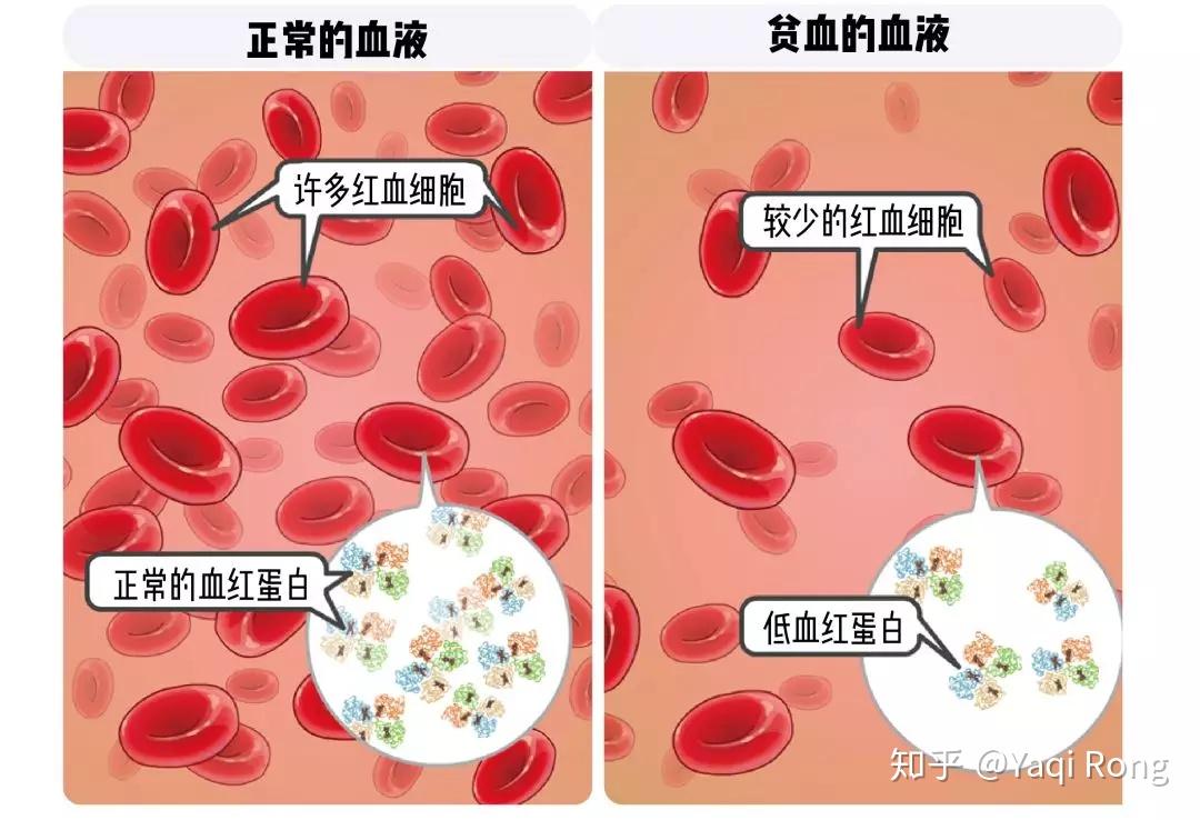 鐵是一種礦物質,60%-75%存在於我們血紅蛋白裡面,所以失血過多會導致