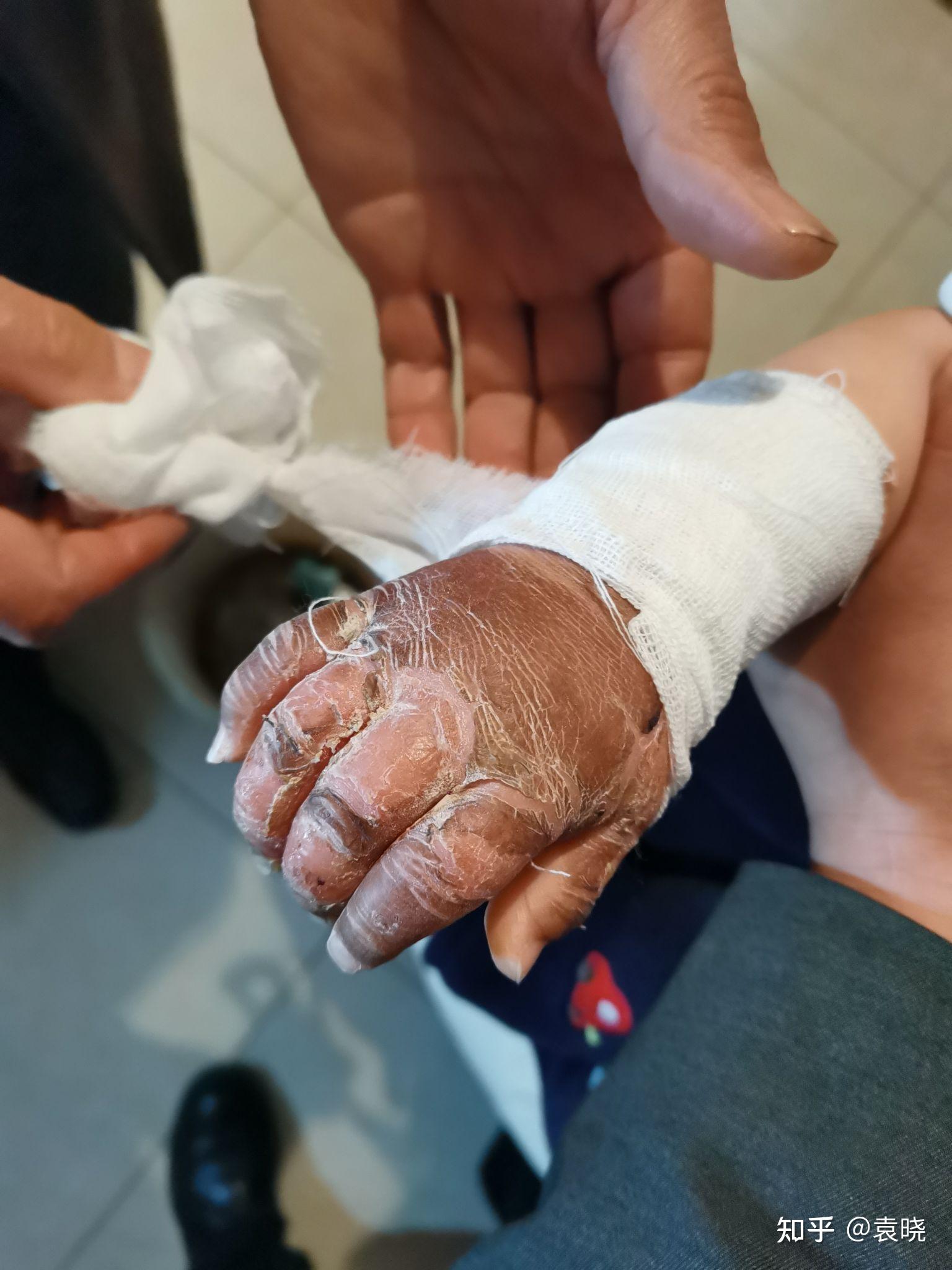 深二度 浅二度烫伤 1岁5个月 中医治疗 - 知乎