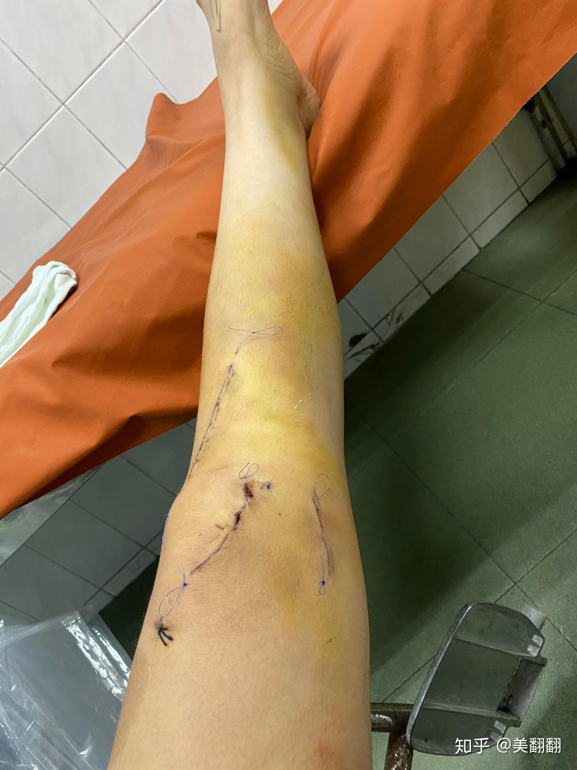 左脚髌骨脱位关节镜松解回忆录