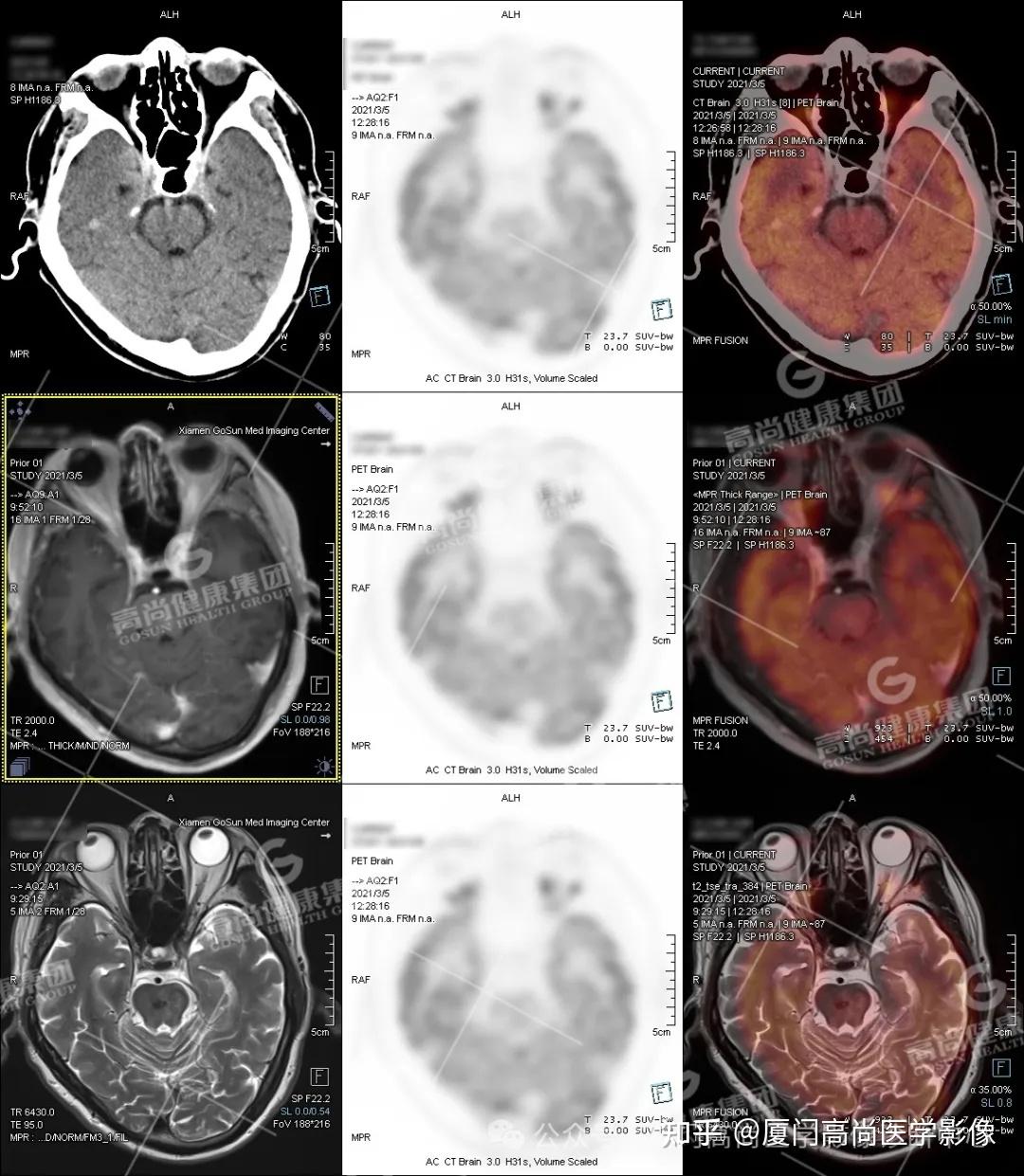【高尚病例】PET/CT-MR 多模态融合技术在临床中的应用病例分享（一） - 知乎