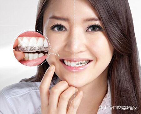 隐形牙套该如何保养和清洗 知乎
