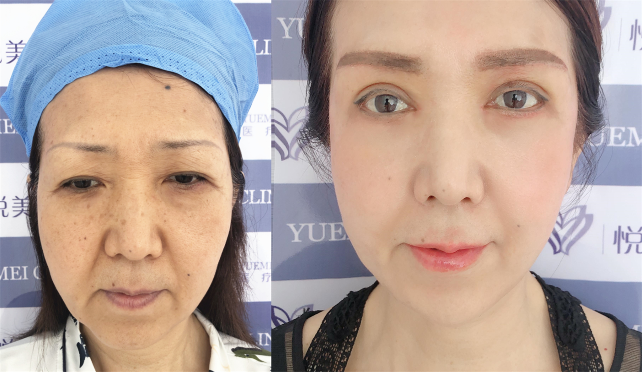 如何避免手术拉皮过度?