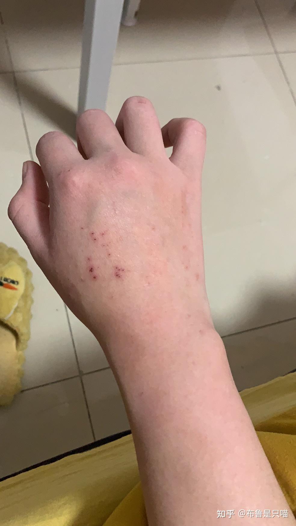 2 6检查结果出来了,还没有转阴啊,但是有位医生建议我直接打乙肝疫苗