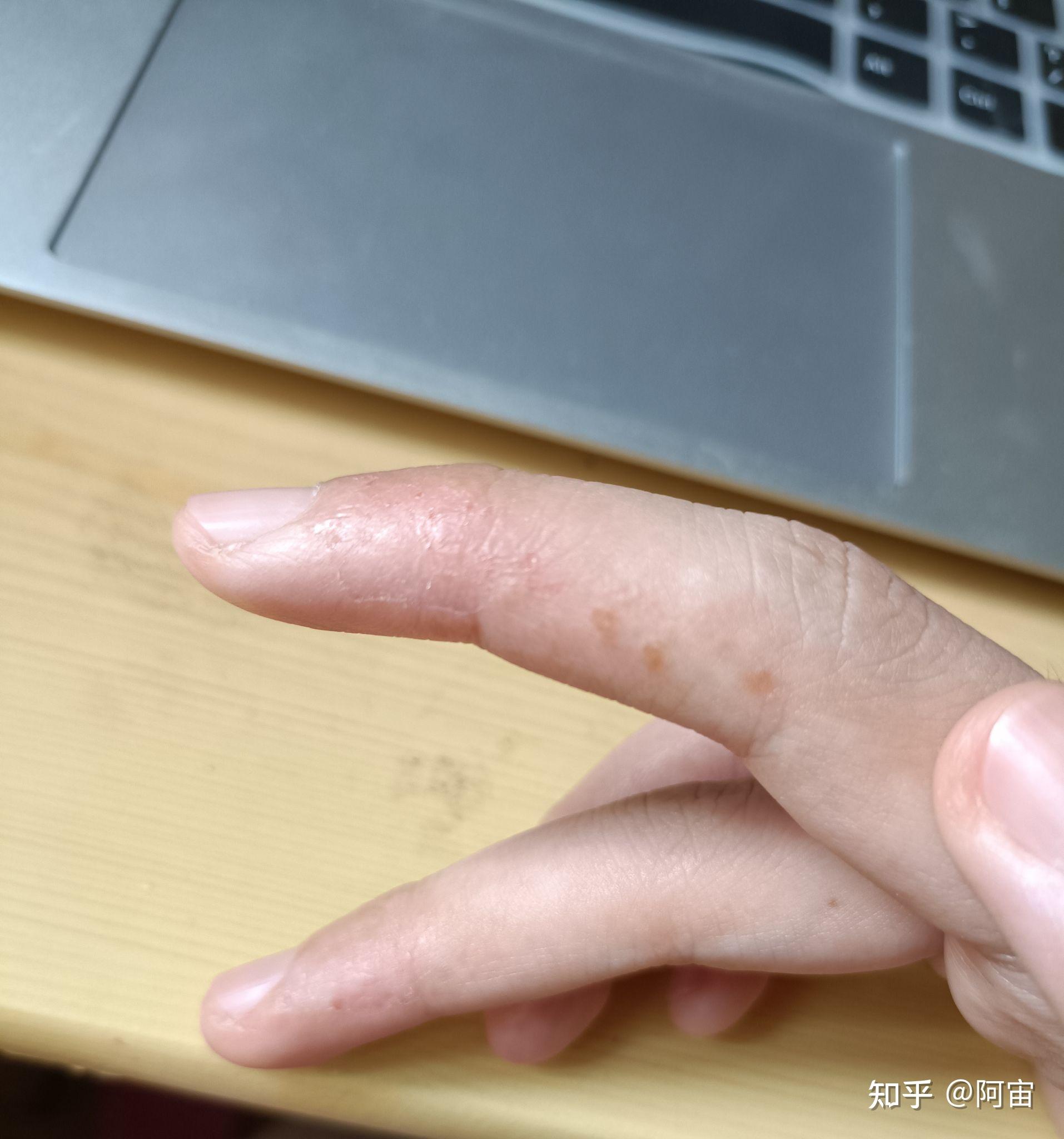 记录一次汗疱疹的痊愈过程