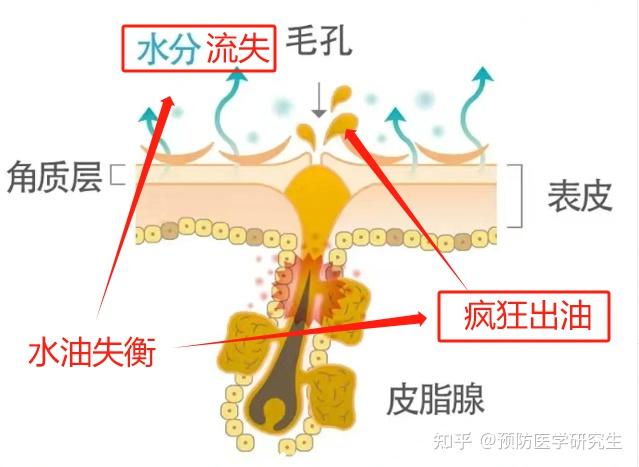 油皮应该怎么样有效护肤?为什么你已经很努力控油了皮肤出油还是很严重?甚至长满了痘痘/闭口/粉刺、黑头,都来学【皮肤科医生】的油皮护肤攻略,科学 ...