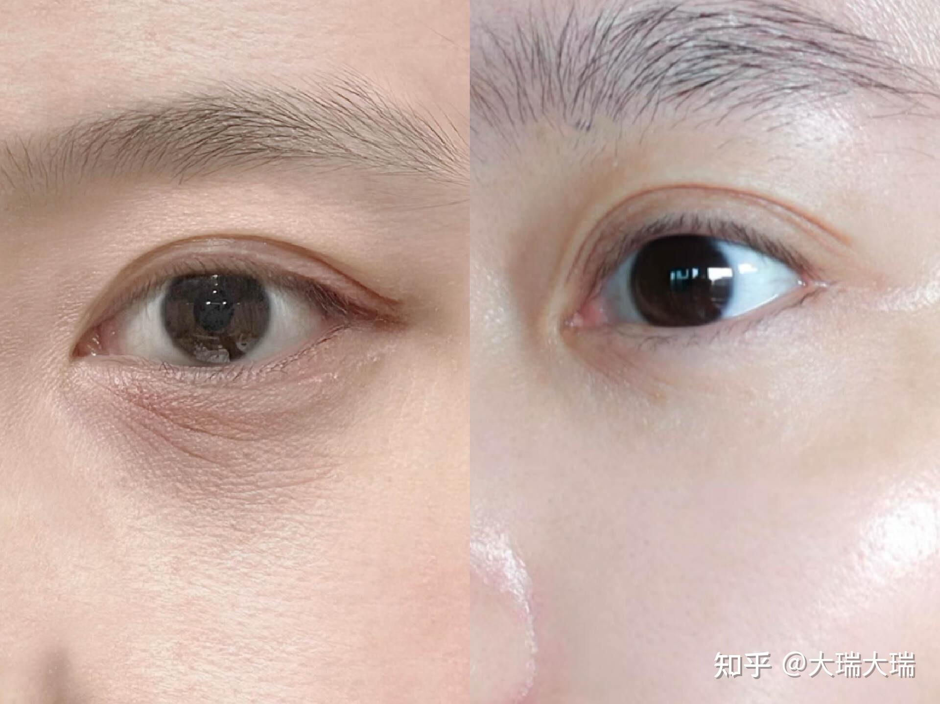 化妆不是解决眼袋眼纹泪沟问题的唯一方法,美容仪才是关键! - 知乎