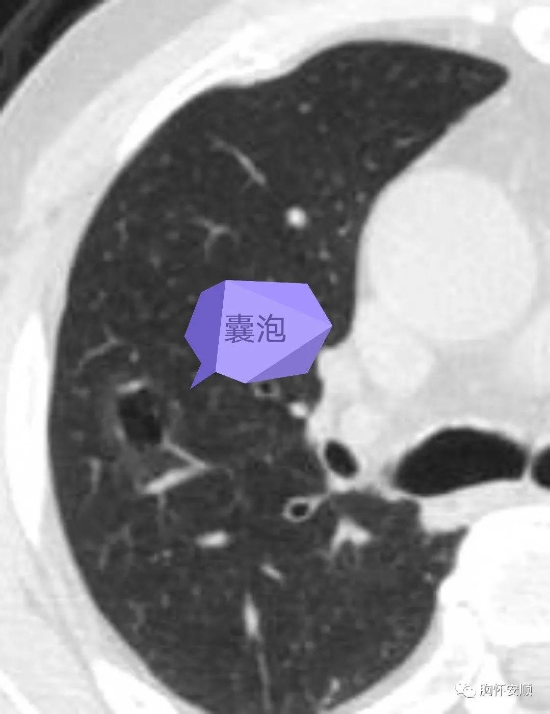 肺泡癌影像诊断与鉴别诊断_细胞