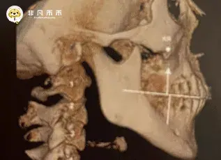 教授经验 近中倾斜磨牙的直立获得间隙内收前牙的临床经验 知乎