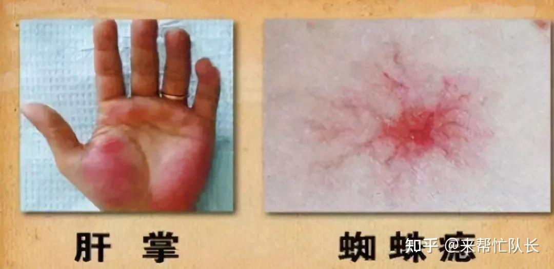 酒精肝到肝癌一般要多久?要改善,戒酒就可以了么?