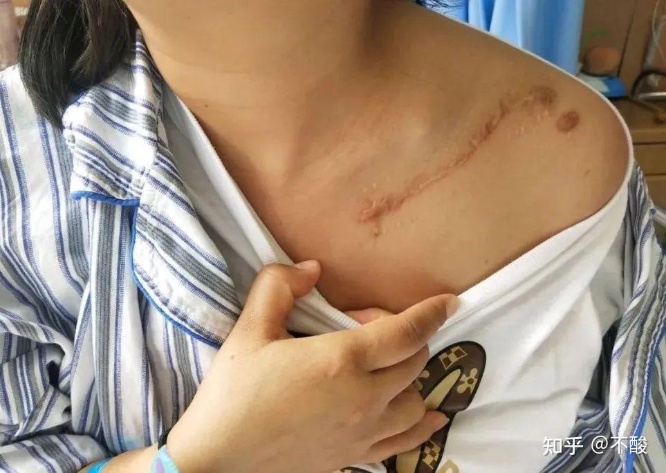 积水潭医院蒋协远团队运用骨科手术机器人完成双侧锁骨骨折微创手术