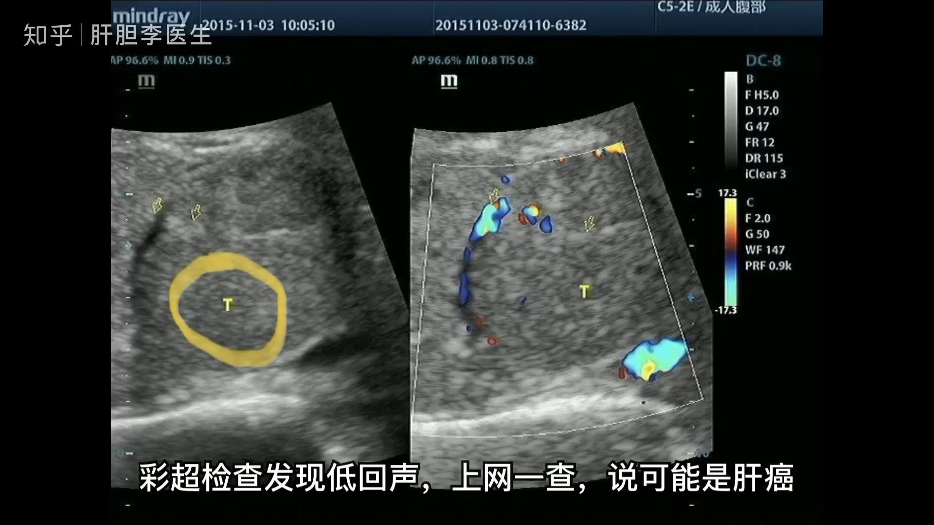 彩超提示胆囊壁增厚,粗糙,欠光滑就一定是胆囊炎吗?