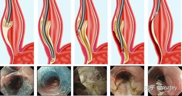 POEM手术：开启贲门失弛缓康复之门 - 知乎