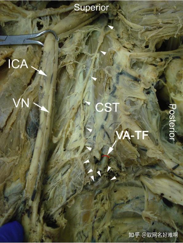 sg通常位於頸部兩側的椎動脈進入橫突孔處(vertebral artery entered