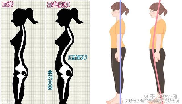 骨盆前倾的真相,你真的了解你的身体吗?