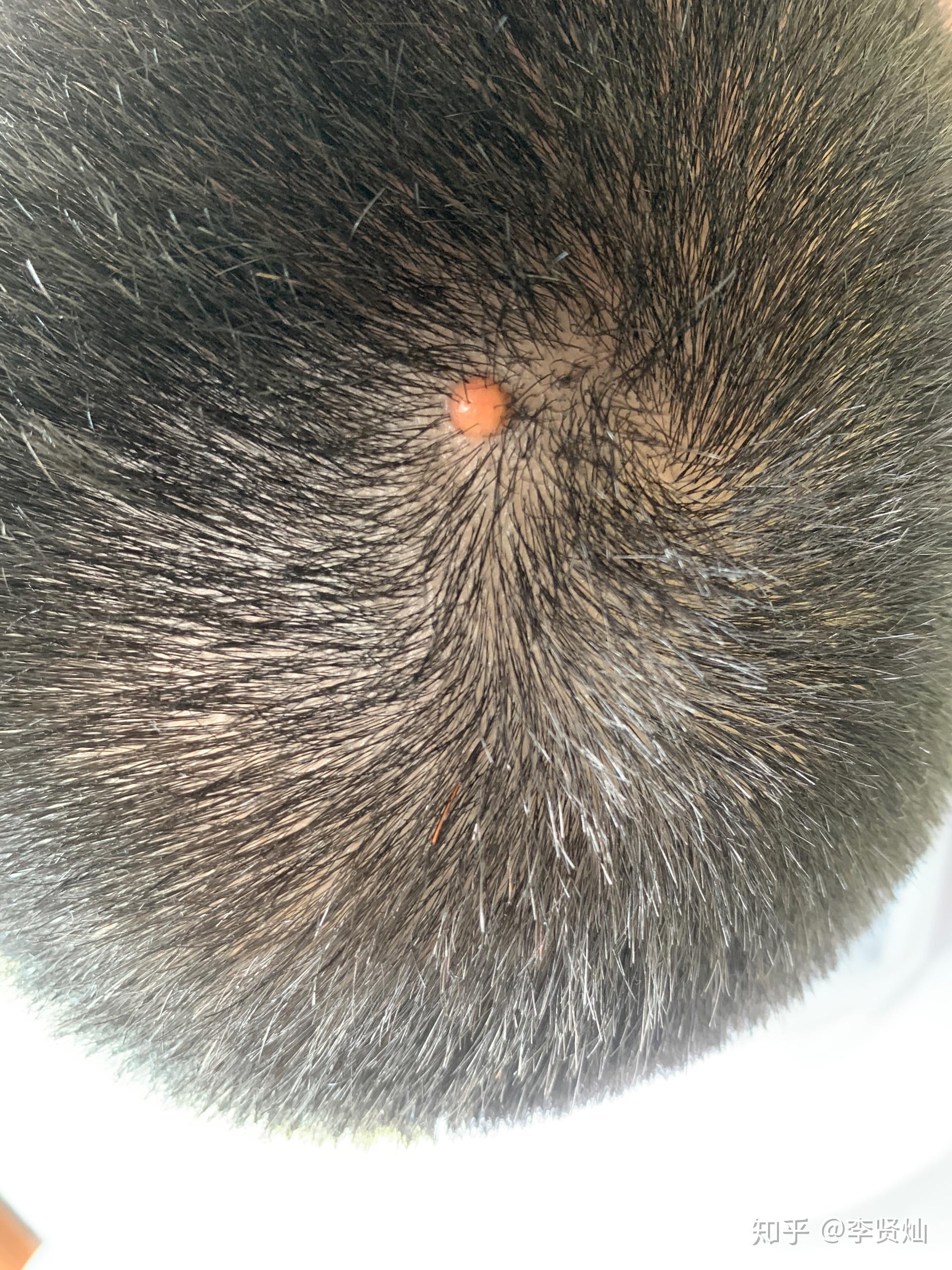 头顶黑色素瘤图片