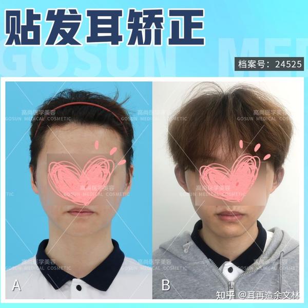 耳朵太靠后贴着脑袋,贴发耳纠正术后脸小了一圈是为什么? - 知乎