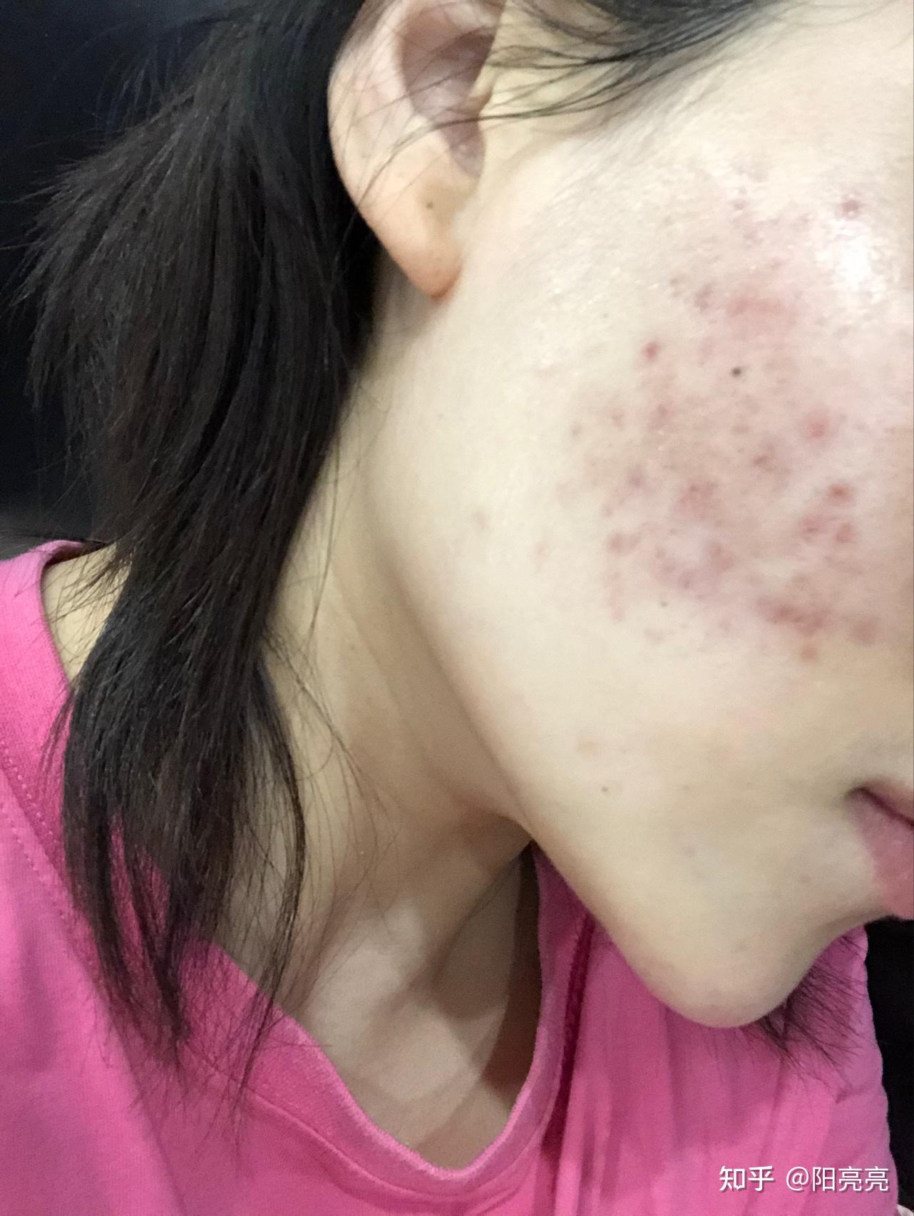 我的满脸痘印还有救吗痘印怎么去除