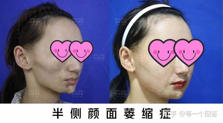 22岁罕见半面侧颜萎缩患者实现美丽变脸杭州美莱李波主任获得实名锦旗