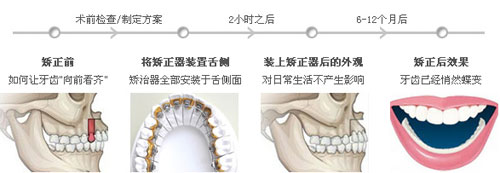舌侧矫正是什么方式?为什么这么贵?如何选择舌侧做得好的医生?