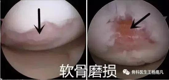 而这是关节镜下看到的磨烂的半月板,已经看不出月牙的形状了,像烂